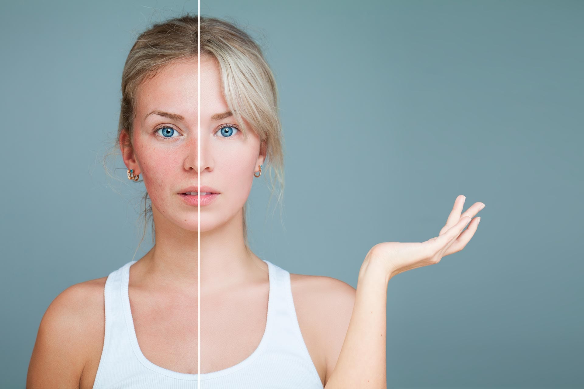 Young Woman with hand raised. Unhealthy and Healthy Skin After Treatment. Facial Treatment, Medicine and Cosmetology Concept. Perfect Skin and Skin Problem.