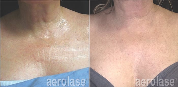 Aerolase Laser Treatment Rock Hill Pennington Med Spa